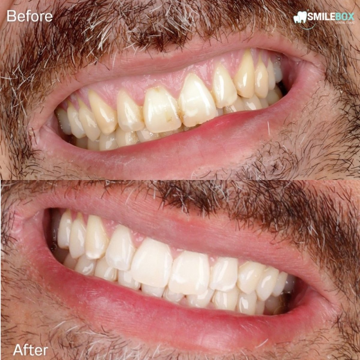Результат до і після лазерного відбілювання зубів у SmileBox Dental Clinic - Тонглор, Сукхумвіт