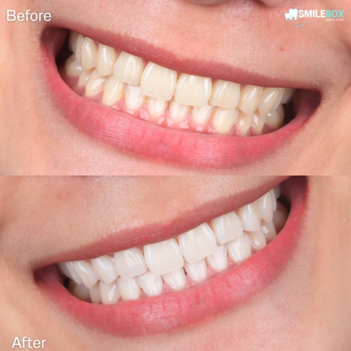 Resultados de blanqueamiento dental láser antes y después en SmileBox Dental Clinic - Thonglor
