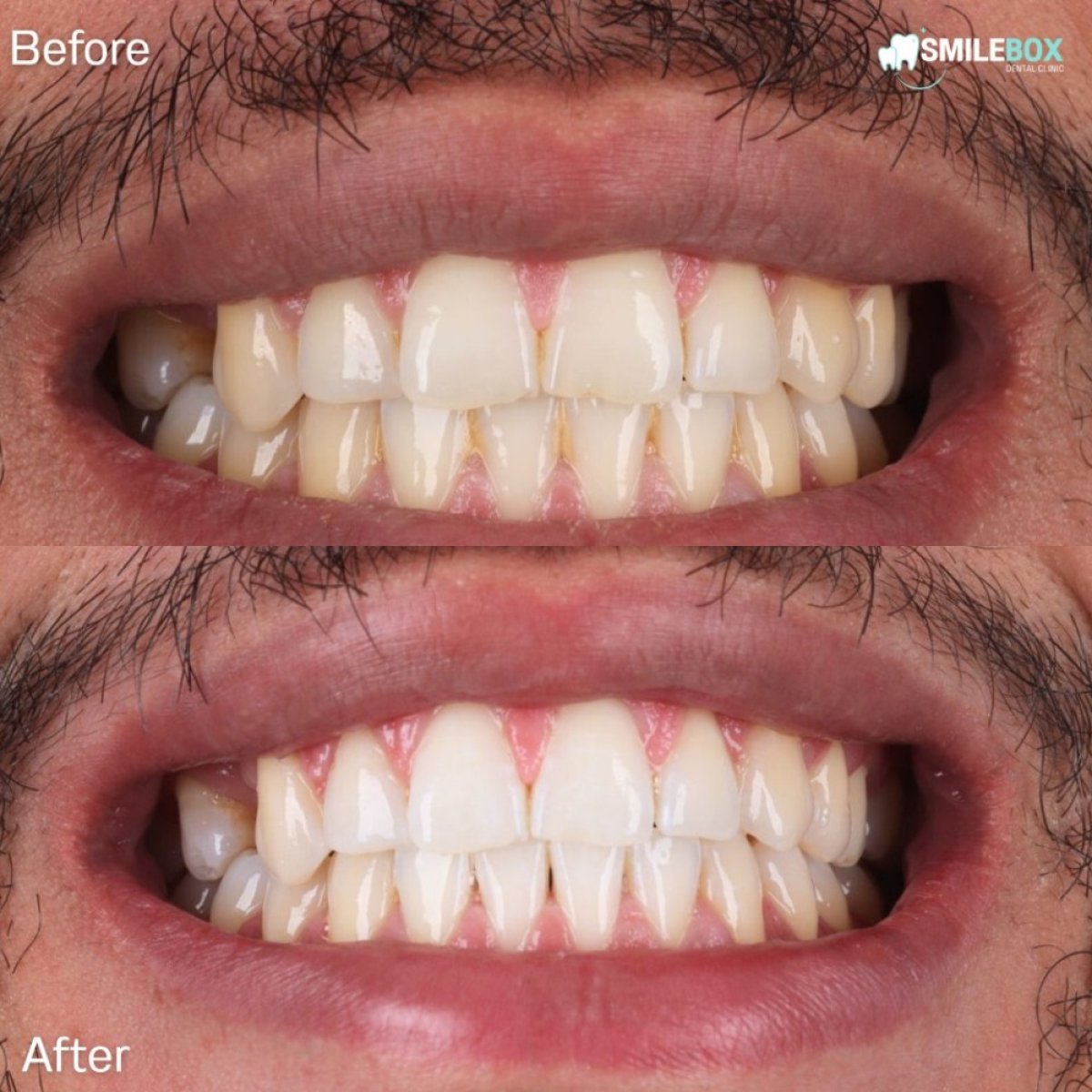 Resultados antes y después del blanqueamiento dental láser en SmileBox Dental Clinic - Thonglor