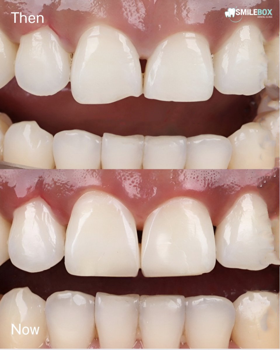 نتائج قبل وبعد عدسات الأسنان الخزفية في SmileBox Dental Clinic - Thonglor