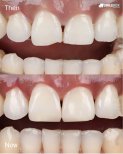 Before and after Porcelain Veneer photos by Dr. 