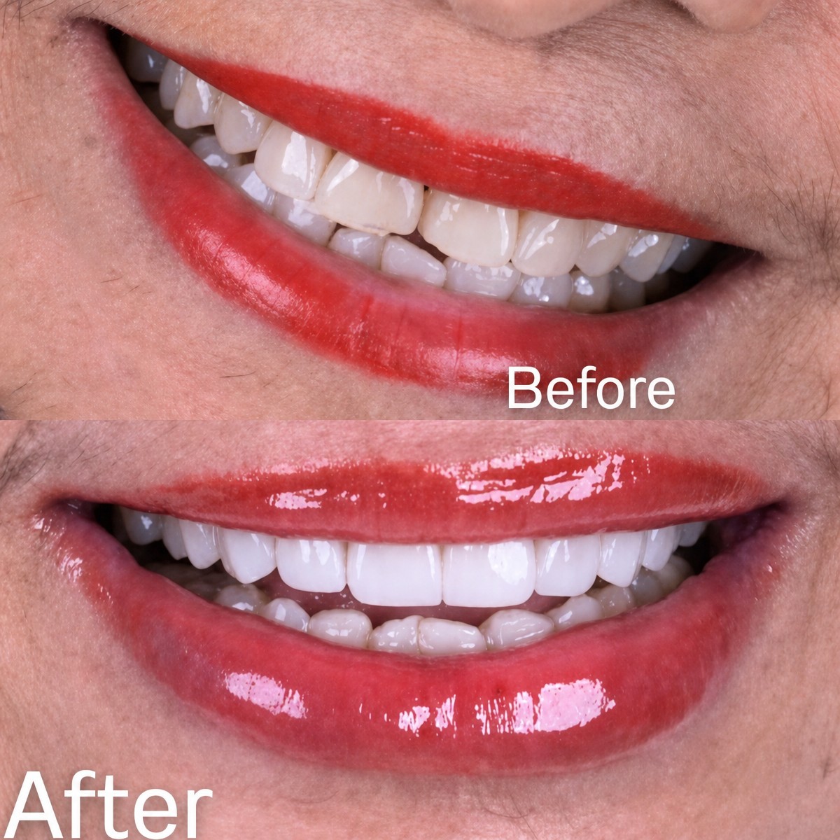 نتائج قبل وبعد قشور البورسلين في SmileBox Dental Clinic - Thonglor، سوخومفيت