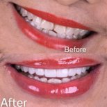 Porcelain Veneer results by Dr. - Patient’s before and after images Before and after Porcelain Veneer photos by Dr.
