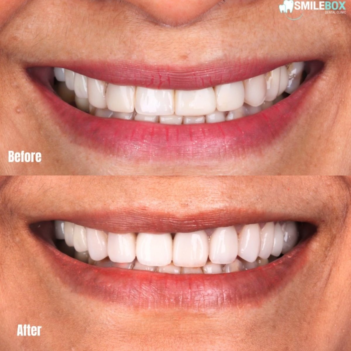 Résultats avant/après facettes en porcelaine à SmileBox Dental Clinic - Thonglor, sourire amélioré