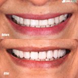 Risultati di Faccetta in porcellana eseguiti dal Dott./Dott.ssa — Foto prima e dopo del paziente Foto prima e dopo di Faccetta in porcellana realizzate dal Dott./Dott.ssa