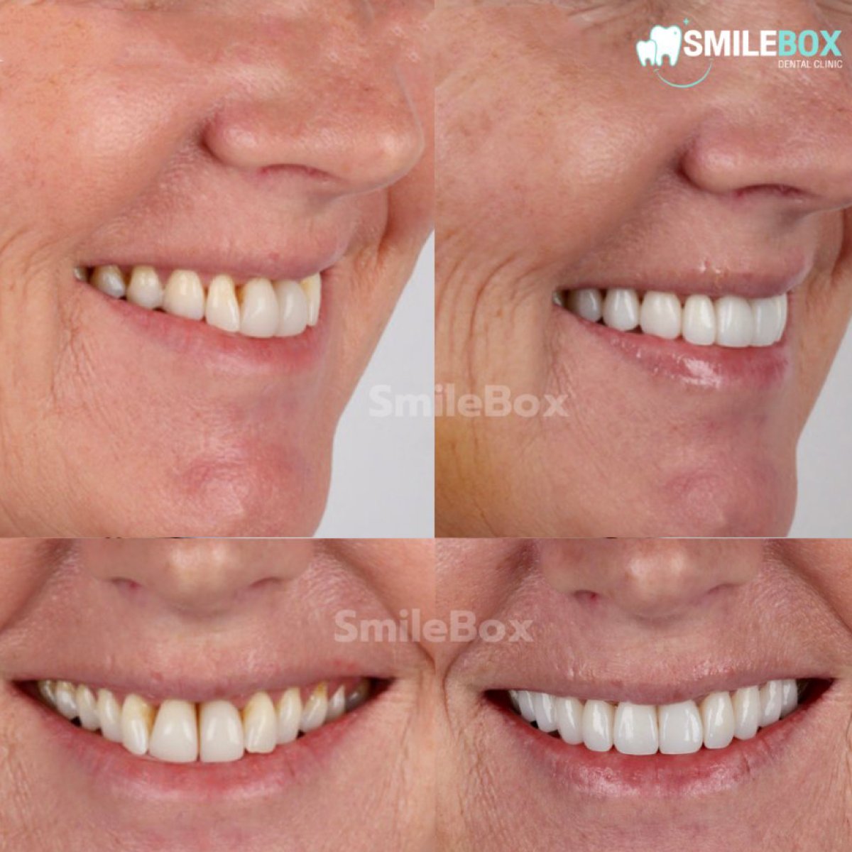 نتائج قبل وبعد قشور البورسلين في SmileBox Dental Clinic - Thonglor، سوخومفيت
