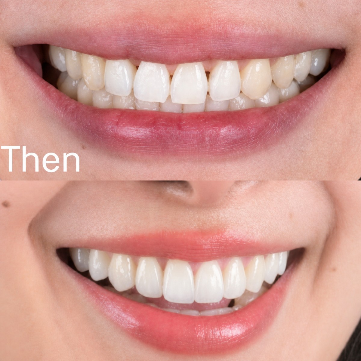 نتائج قبل وبعد قشور البورسلين في SmileBox Dental Clinic - Thonglor، سوخومفيت