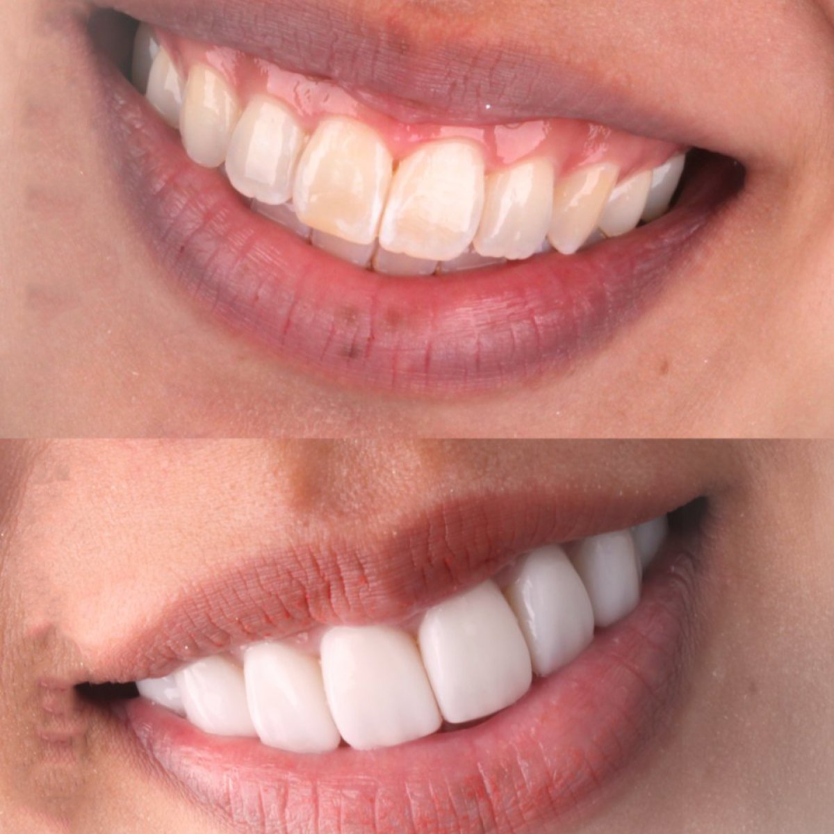 Résultats avant/après facettes en porcelaine à SmileBox Dental Clinic - Thonglor