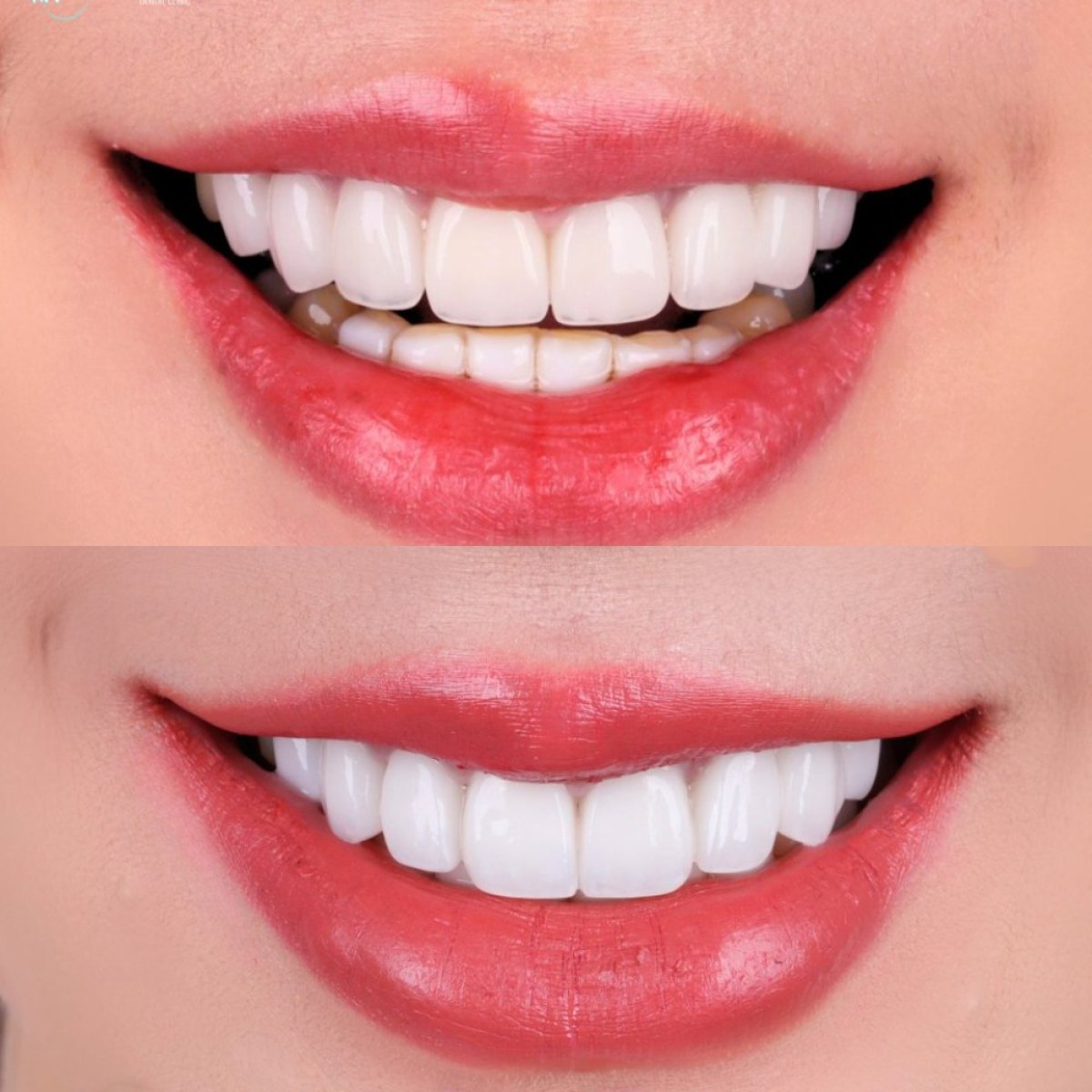 Resultados antes y después de carillas de porcelana en SmileBox Dental Clinic - Thonglor