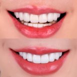 Before and after Porcelain Veneer photos by Dr. 