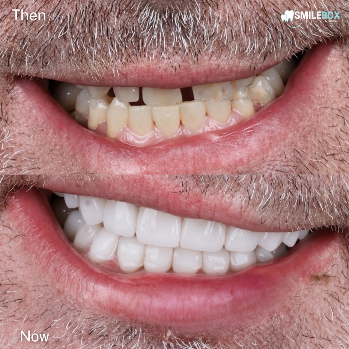 Smile makeover before and after results at SmileBox Dental Clinic - Thonglor, Sukhumvit Branch