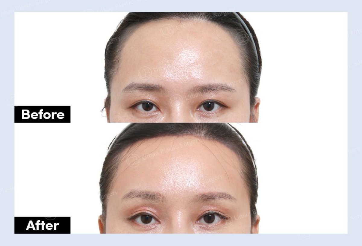 Результаты блефаропластики верхних век до и после в URBAN Plastic Surgery, улучшение взгляда