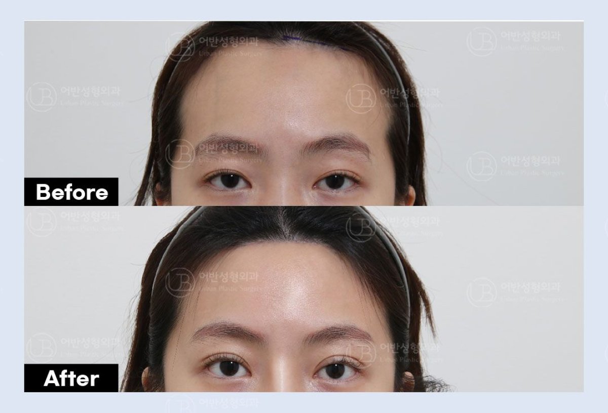 Before and after upper eyelid surgery results at URBAN Plastic Surgery, improved eye appearance