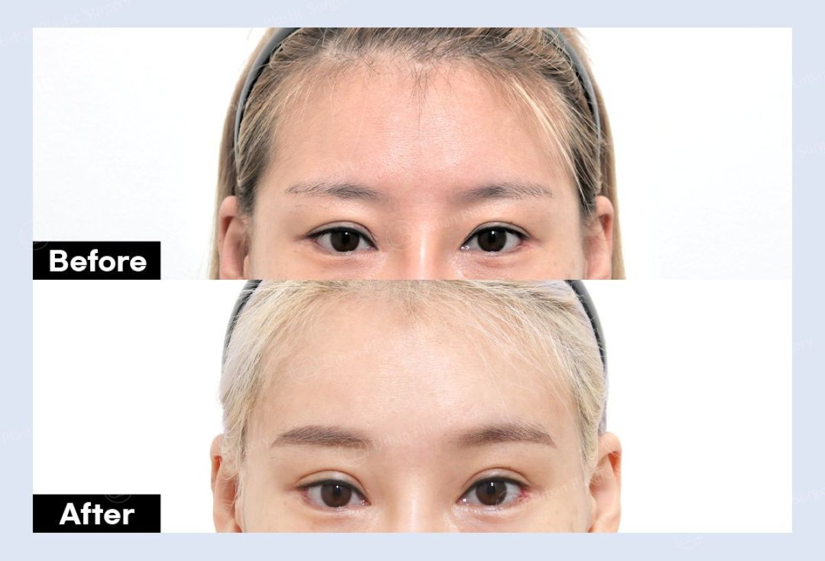 Resultados de blefaroplastia superior antes y después en URBAN Plastic Surgery, ojos mejorados