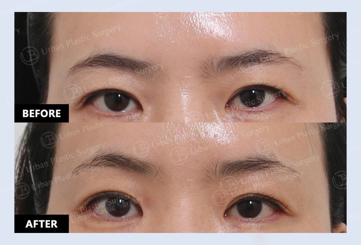 Before and after upper eyelid surgery results at URBAN Plastic Surgery, improved eye contour