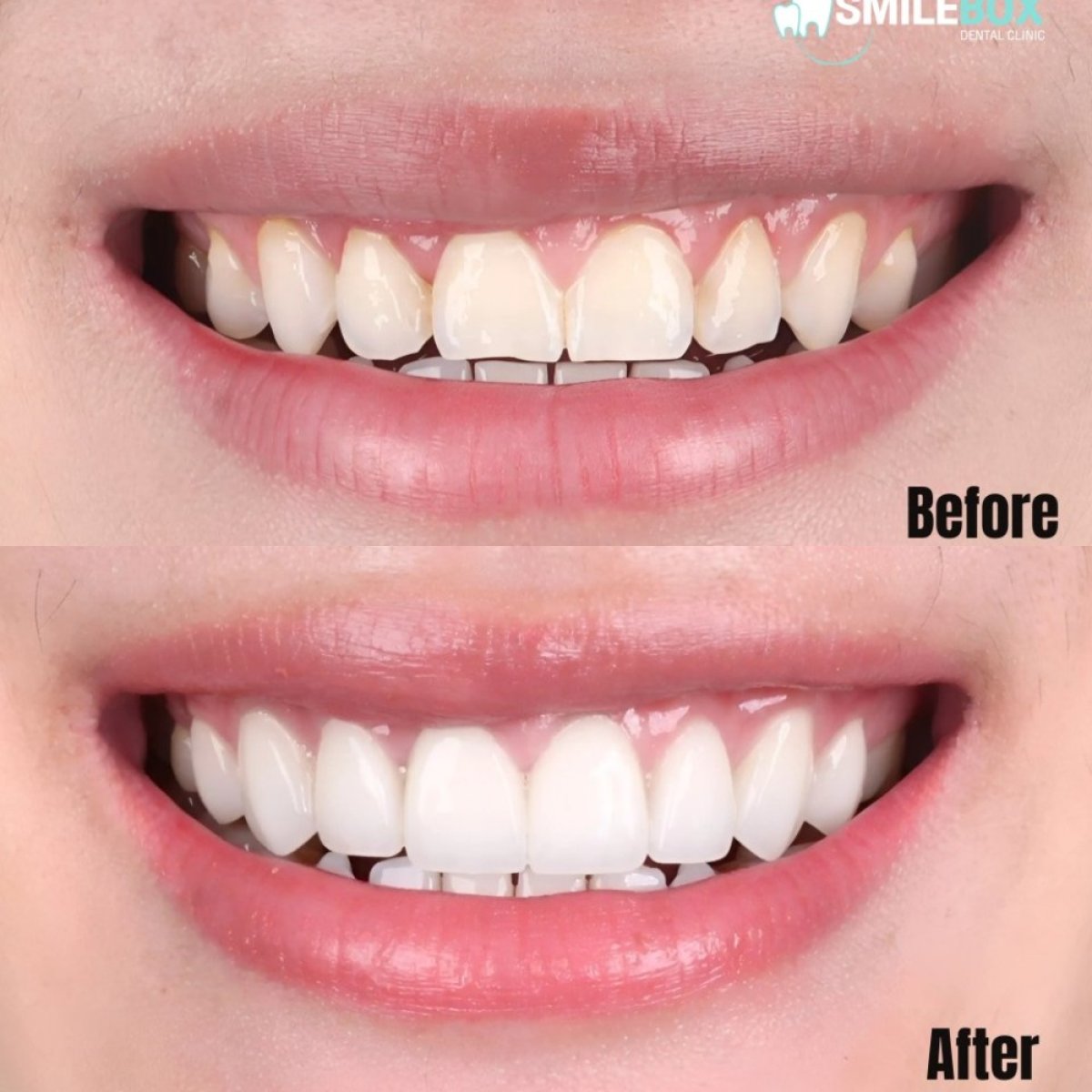 Smile makeover before and after results at SmileBox Dental Clinic - Thonglor, Sukhumvit Branch