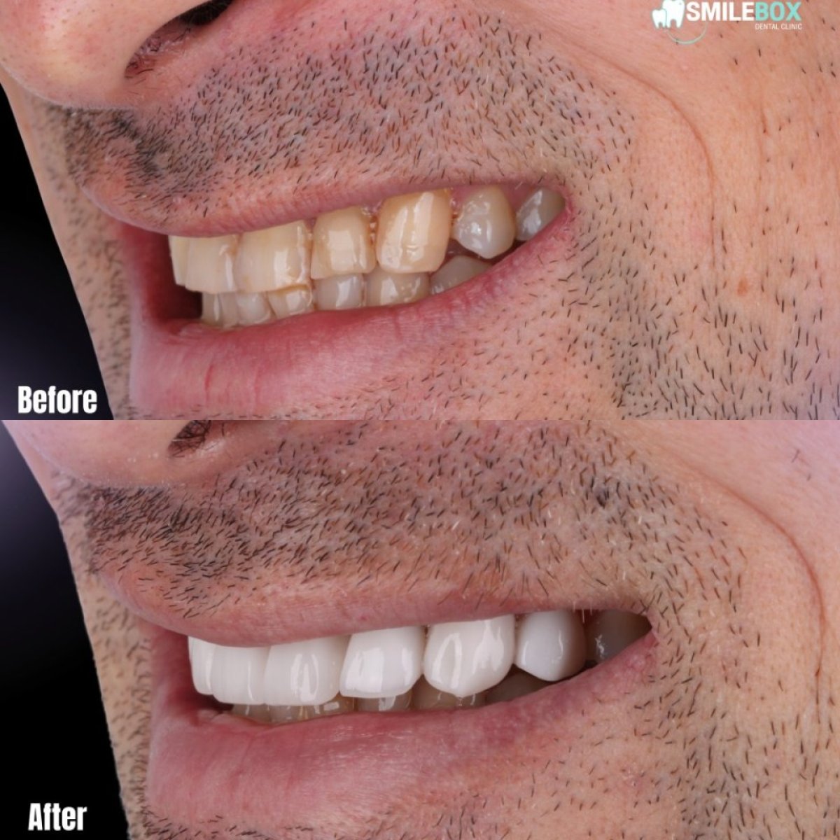 Resultados de cambio de sonrisa antes y después en SmileBox Dental Clinic - Thonglor, Sukhumvit Branch