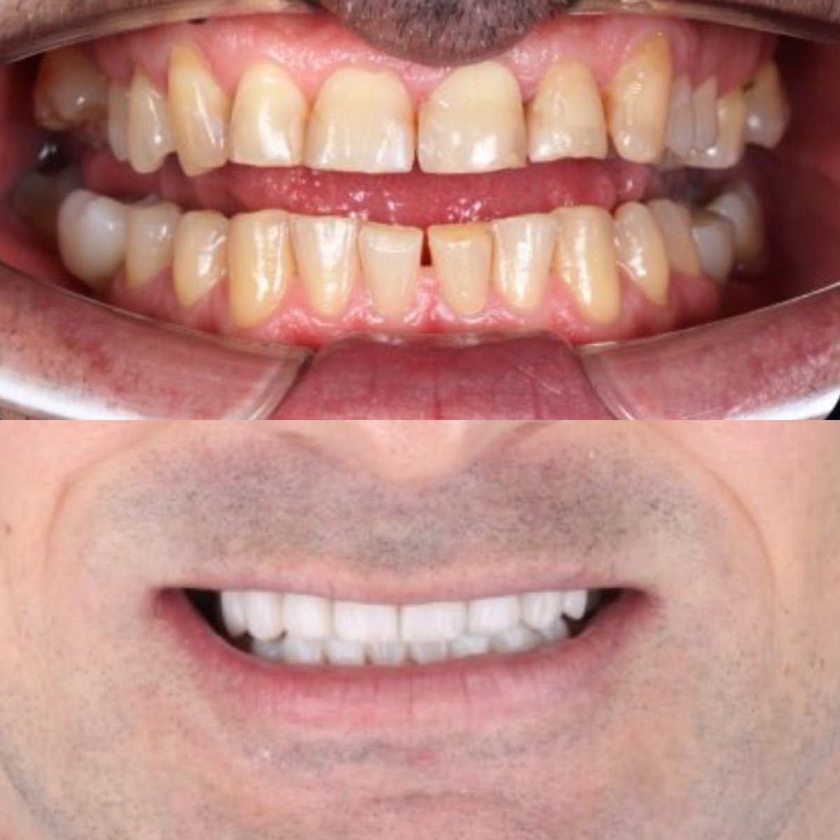 Resultados de antes y después de cambio de sonrisa en SmileBox Dental Clinic - Thonglor, Sukhumvit Branch