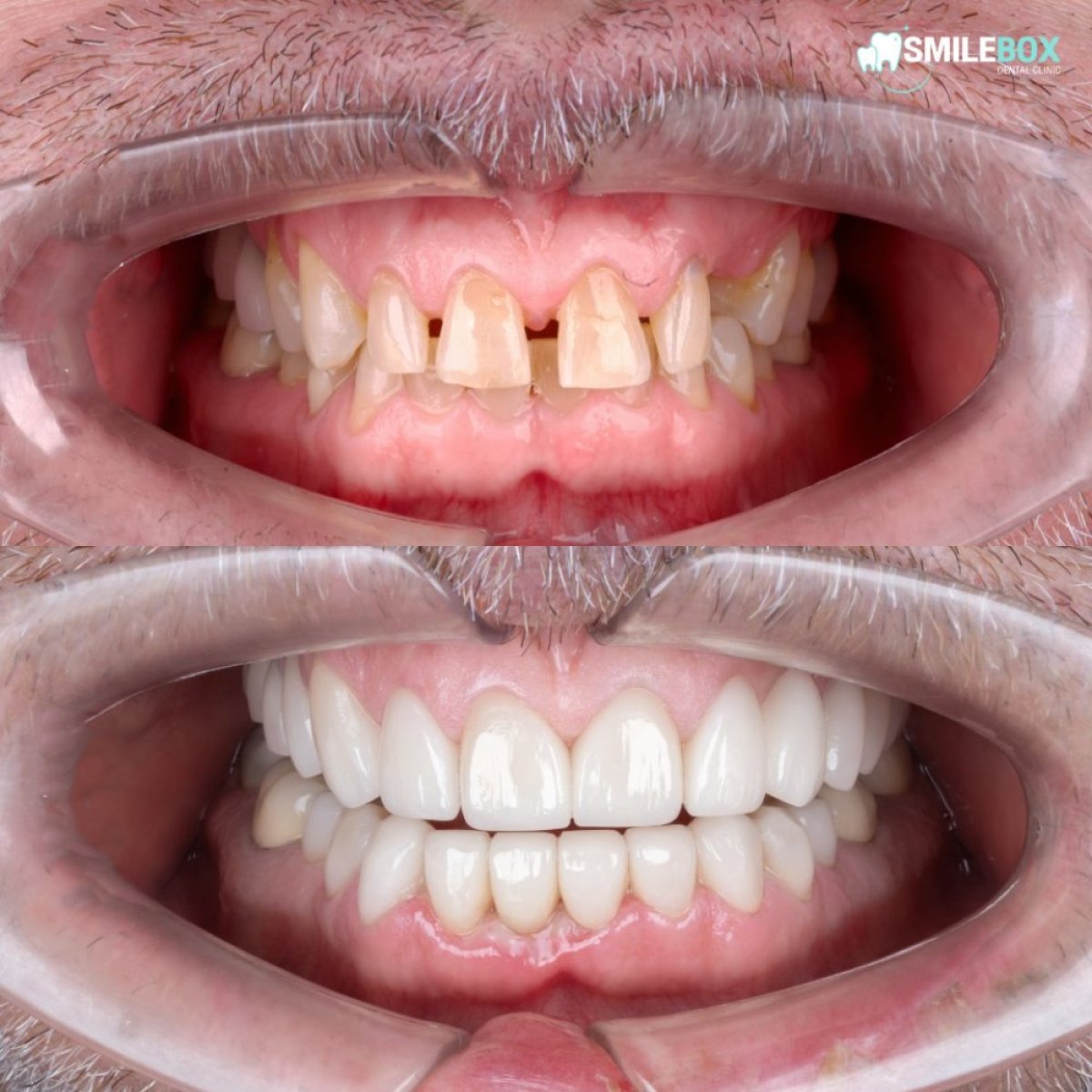Smile makeover before and after results at SmileBox Dental Clinic - Thonglor, Sukhumvit Branch