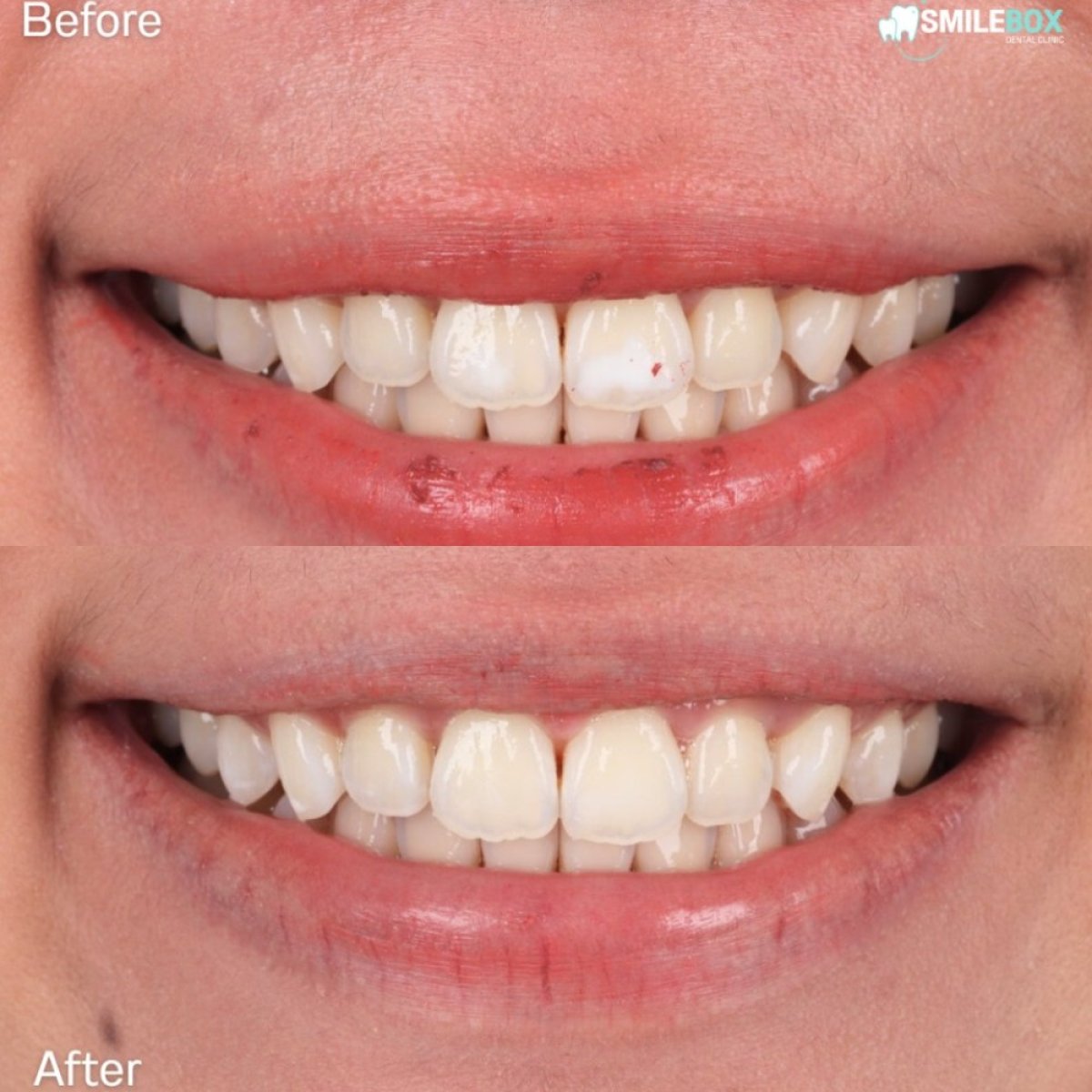 Результаты лазерного отбеливания зубов до и после в SmileBox Dental Clinic - Тонглор, Сукхумвит