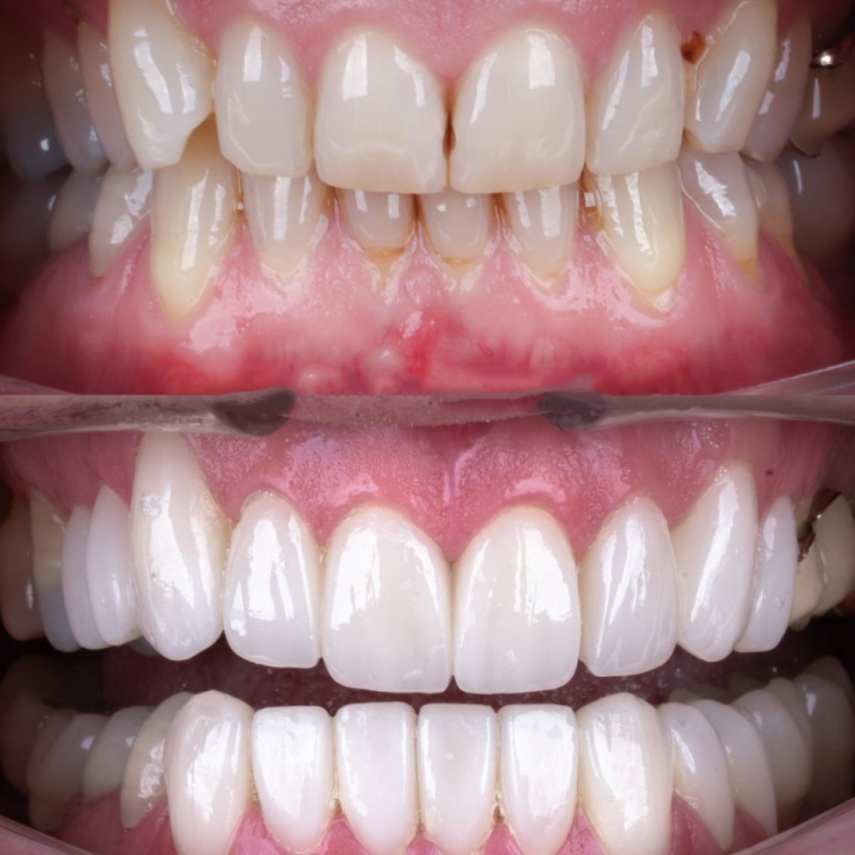 Smile makeover before and after results at SmileBox Dental Clinic - Thonglor, Sukhumvit Branch