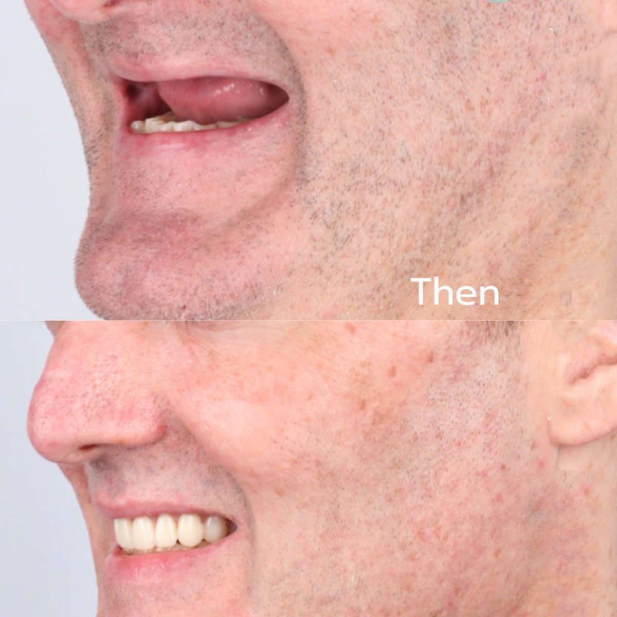 Before and after 4-implant overdenture with CAD/CAM titanium bar at SmileBox Dental Clinic result