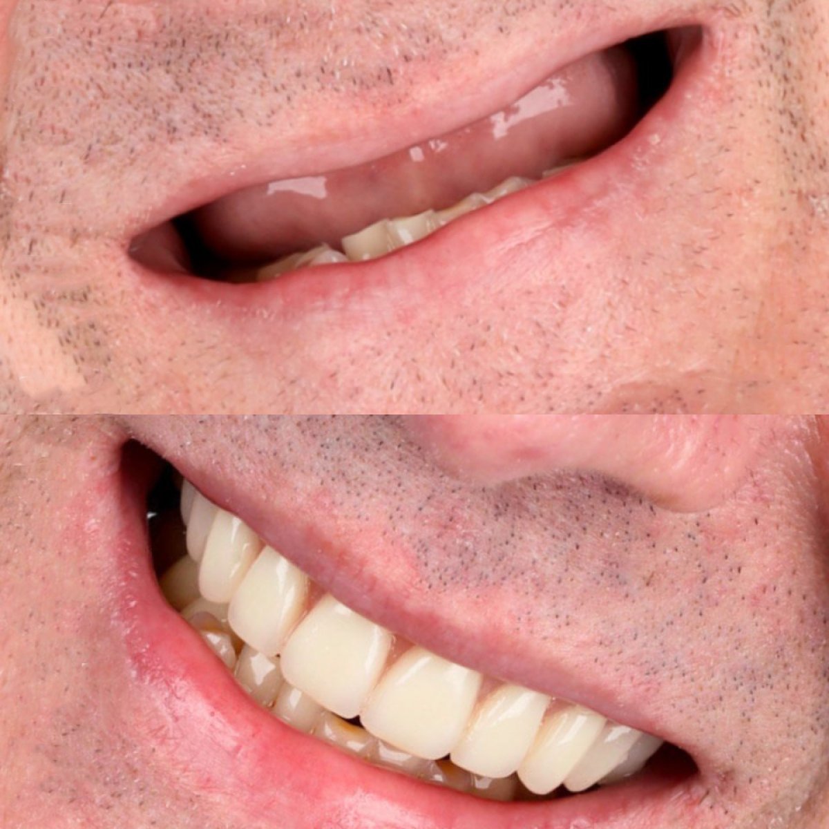 Before and after 4-implant overdenture with CAD/CAM titanium bar at SmileBox Dental Clinic result
