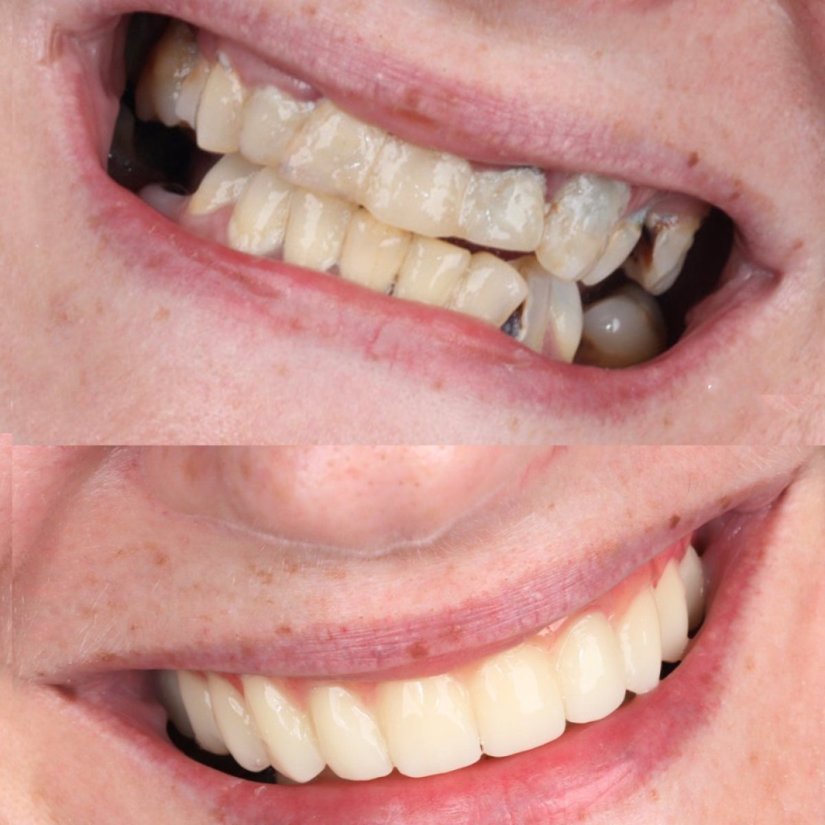 Résultat avant/après implants All-on-4 à SmileBox Dental Clinic - Thonglor, Sukhumvit