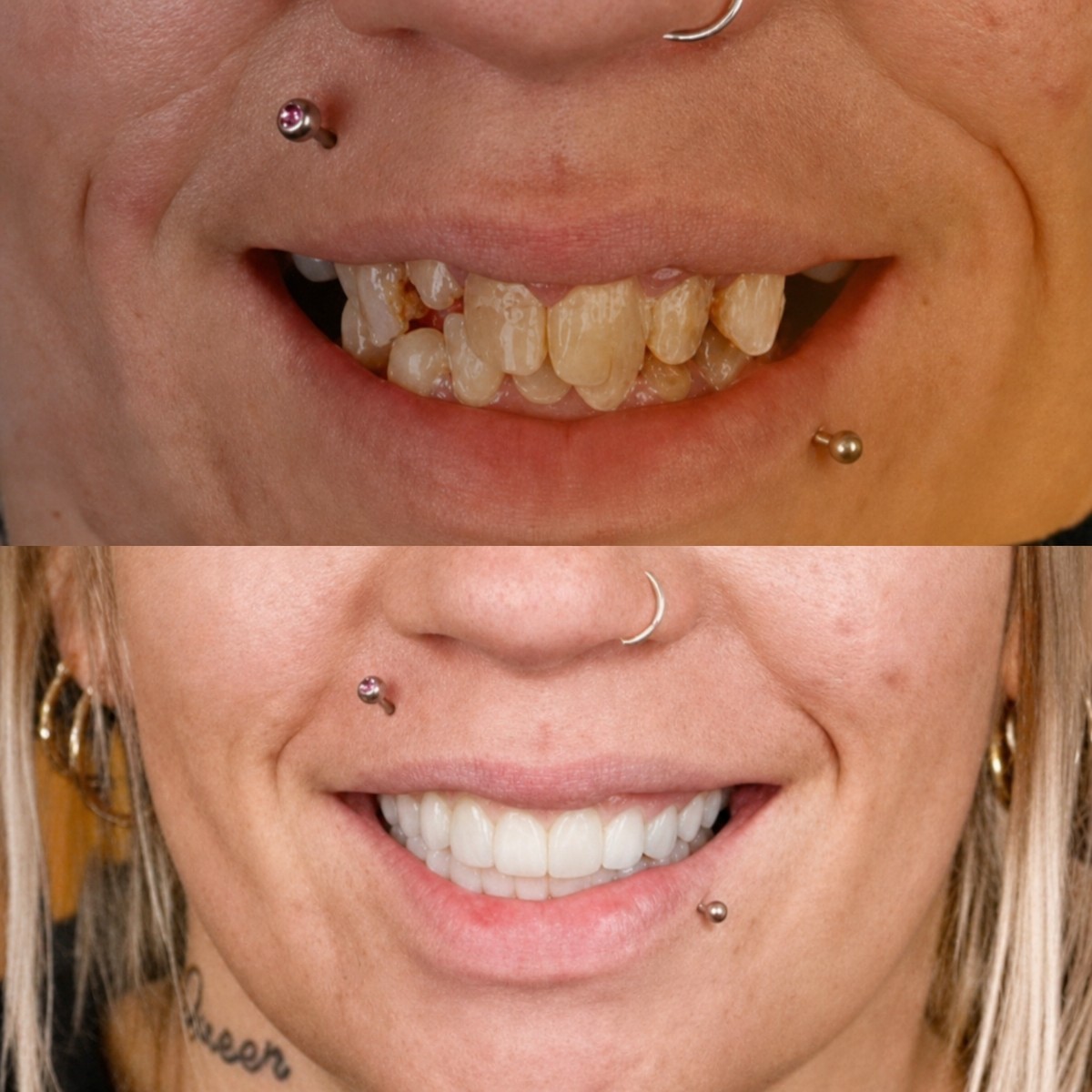 Resultados antes y después de implantes All-on-4 en SmileBox Dental Clinic - Thonglor