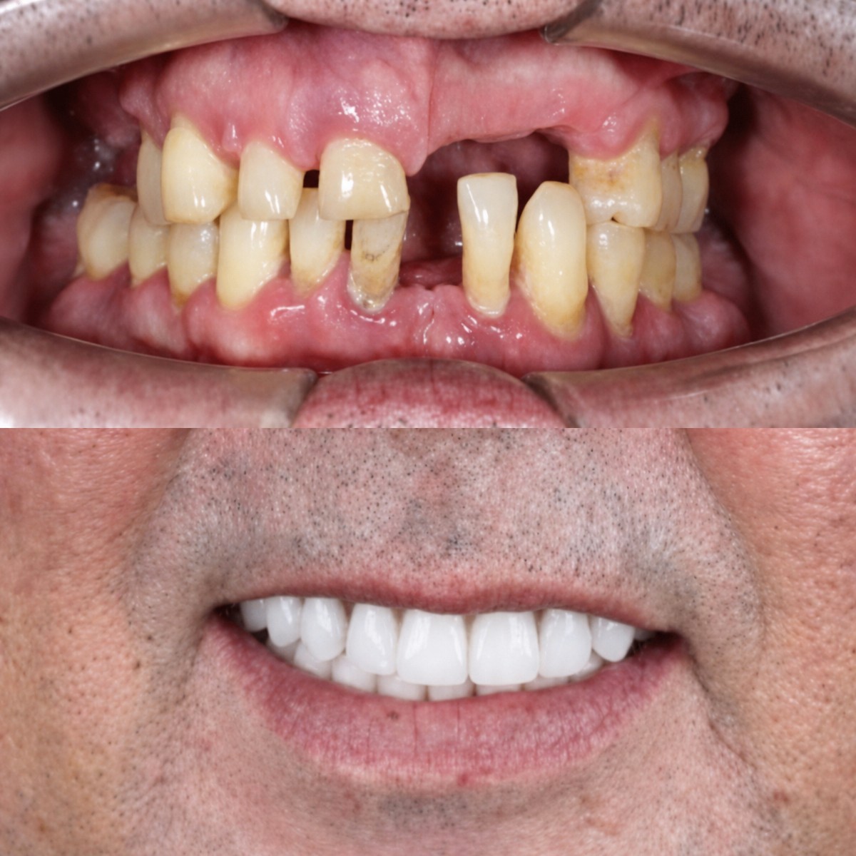 Resultado antes y después de implantes All-on-4 en SmileBox Dental Clinic - Thonglor, Sukhumvit