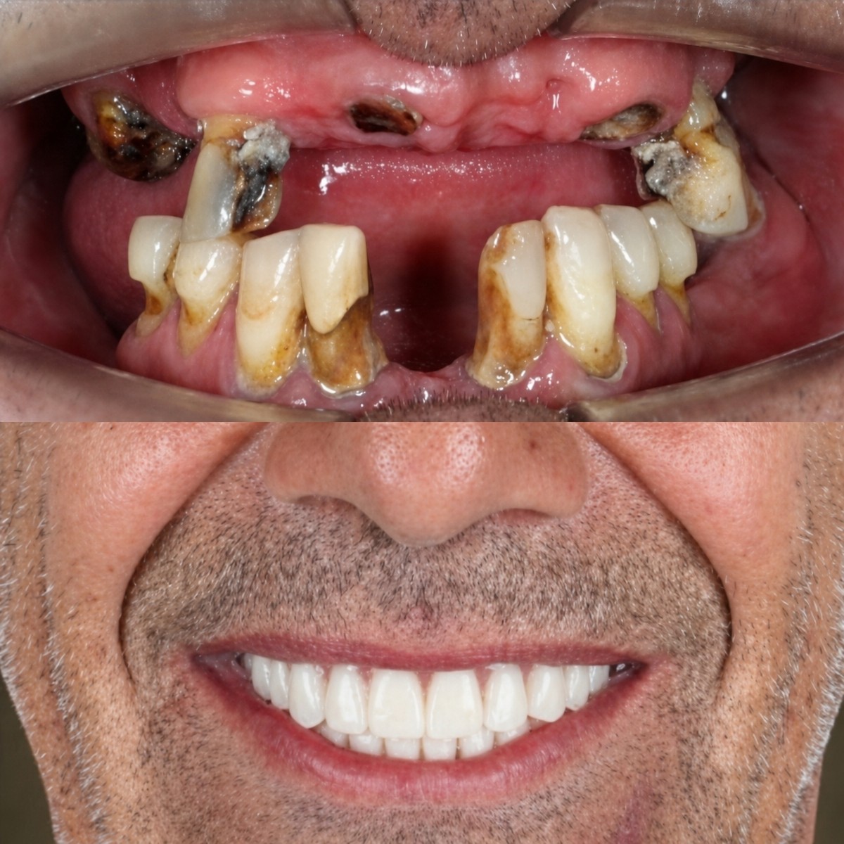 Before and after All-on-4 dental implants result at SmileBox Dental Clinic - Thonglor, Sukhumvit