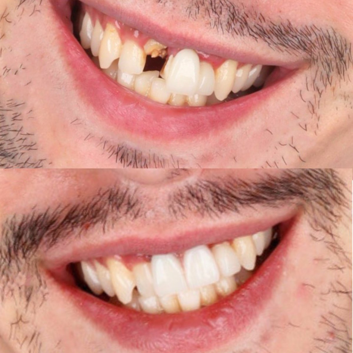 Résultat avant et après implant dentaire à SmileBox Dental Clinic - Thonglor, sourire amélioré