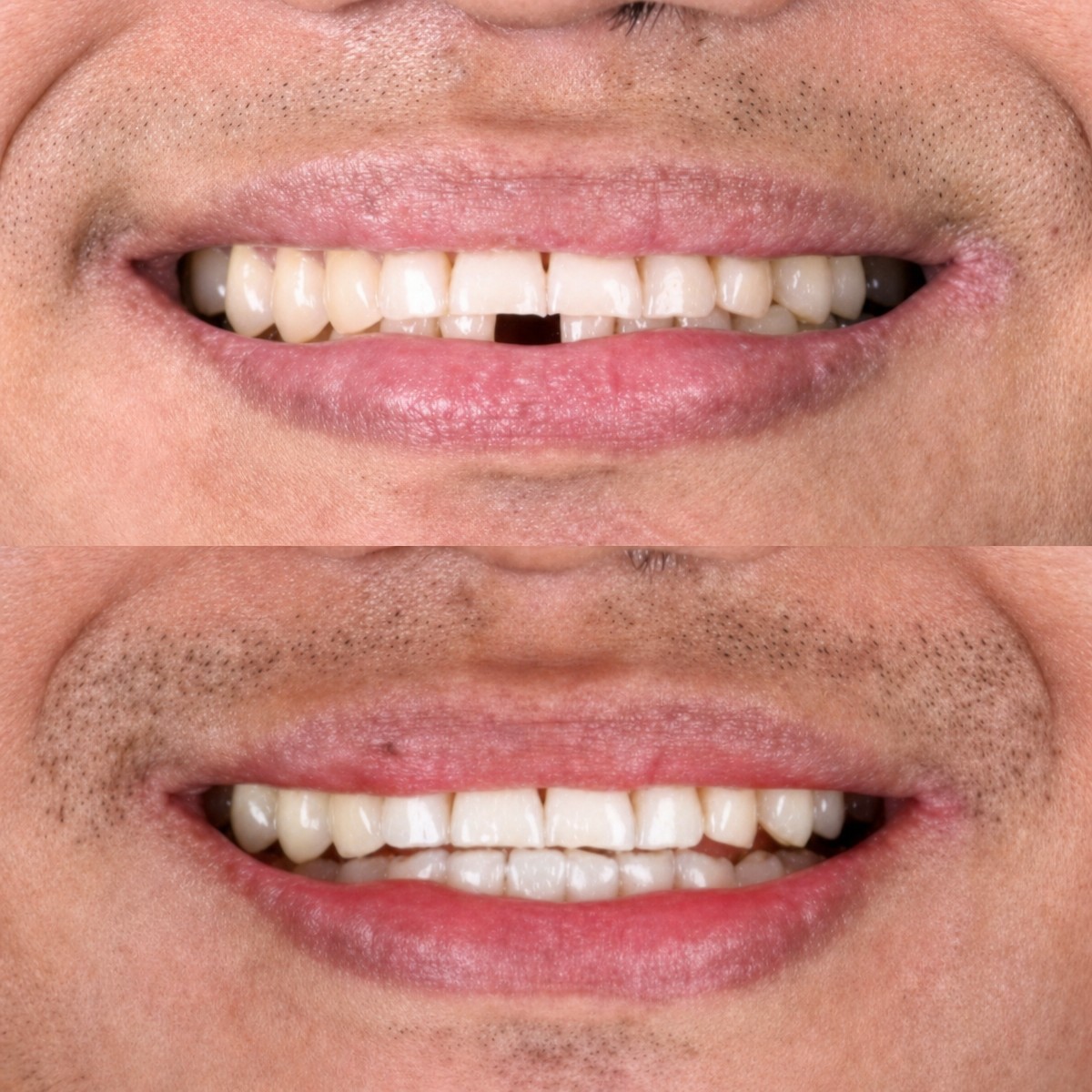 Efekty przed i po implantacji zęba w SmileBox Dental Clinic - Thonglor, poprawiony uśmiech