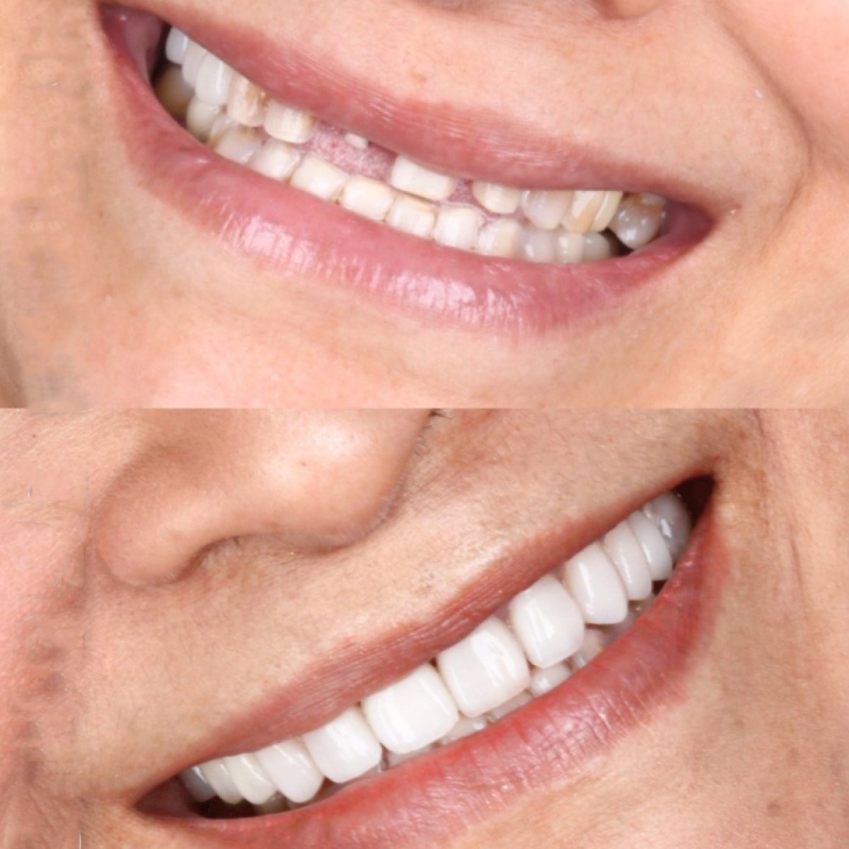 Efekty przed i po implantacji zębów w SmileBox Dental Clinic - Thonglor, Sukhumvit Branch