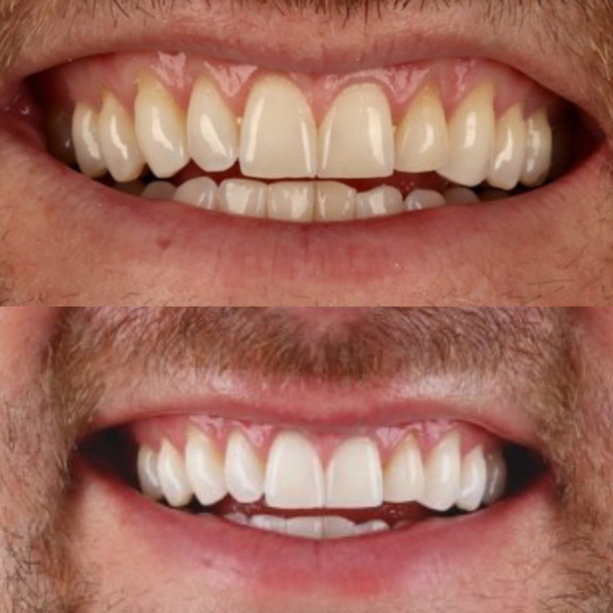 Resultados antes y después del blanqueamiento dental láser en SmileBox Dental Clinic - Thonglor, Sukhumvit