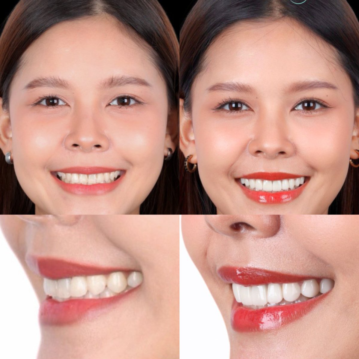 نتائج قبل وبعد قشور البورسلين في SmileBox Dental Clinic - Thonglor, Sukhumvit Branch