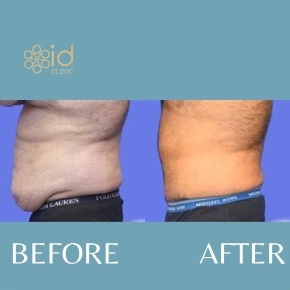 Before and after Vaser 3 areas plus tummy tuck results at ID Clinic Bangkok, flatter abdomen