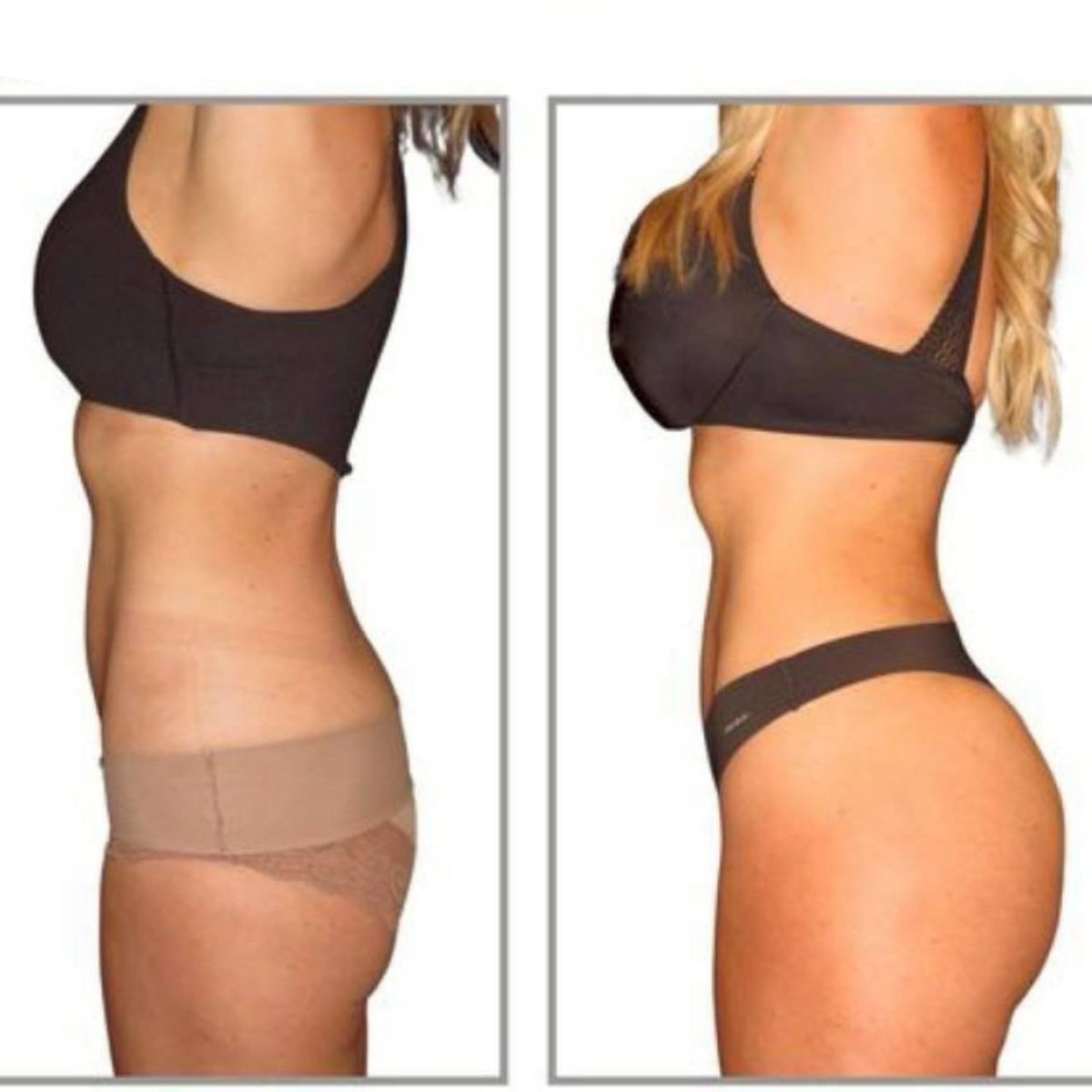 Before and after buttock lift results at ID Clinic Bangkok, enhanced contour and volume