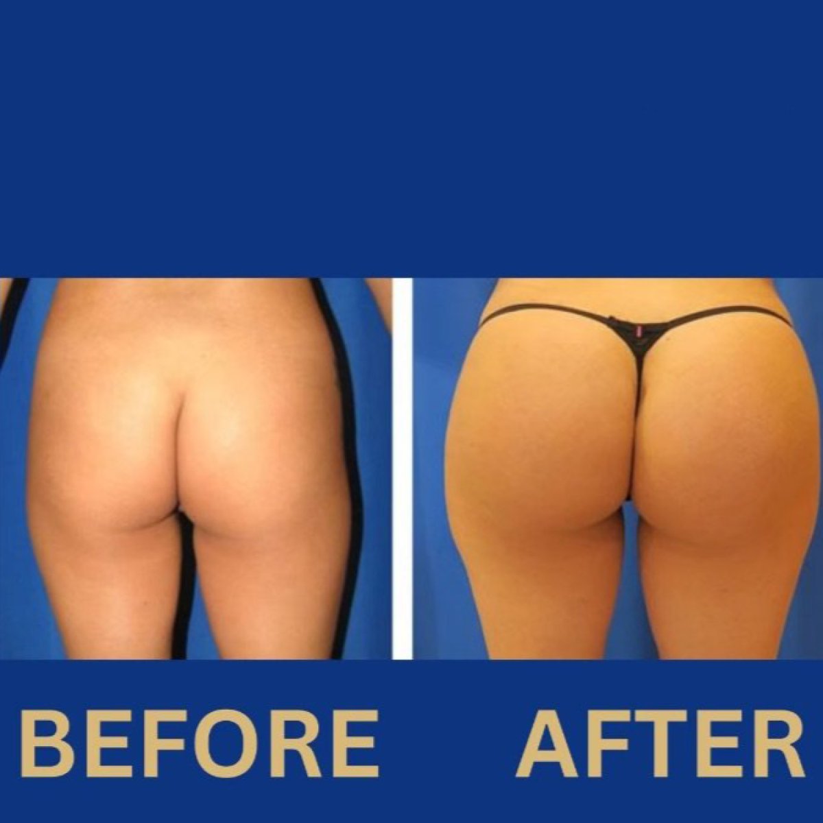 Before and after buttock lift results at ID Clinic Bangkok, enhanced contour and firmness