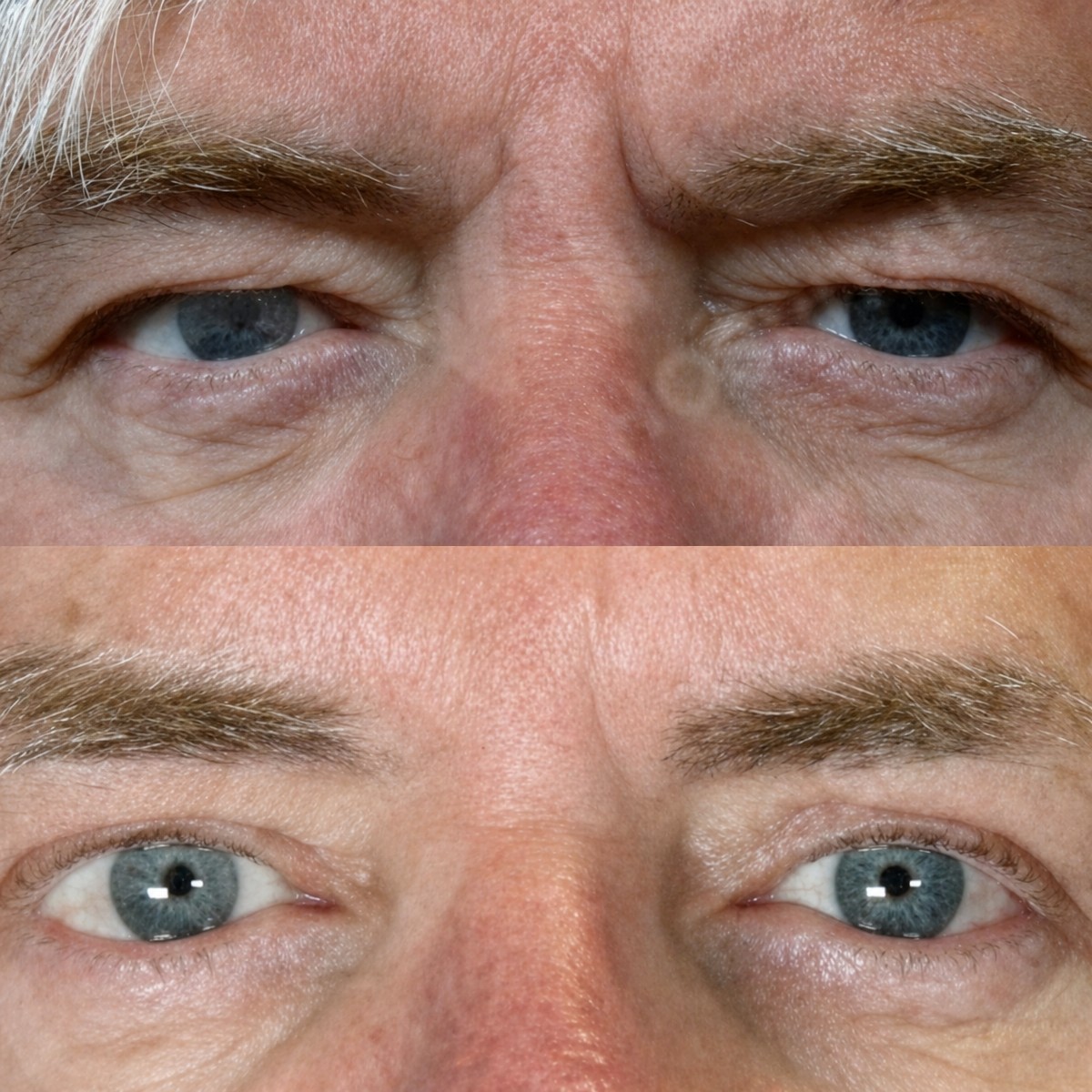Vorher-nachher-Ergebnis der Blepharoplastik in Adem and Havva Medical Center, Lidkorrektur