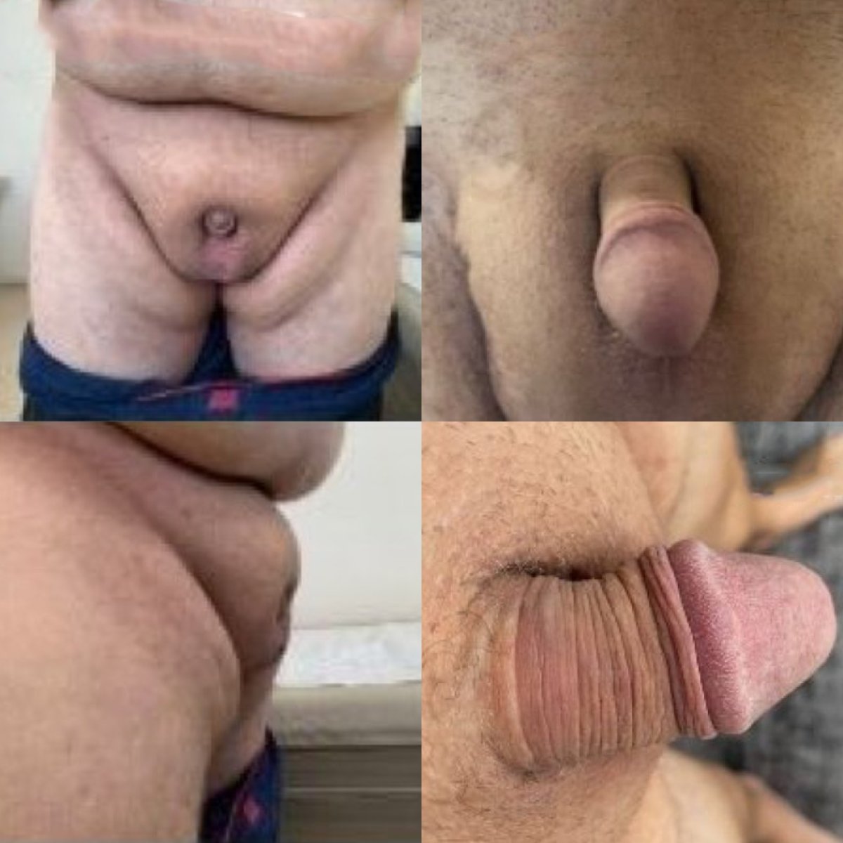 Résultats avant/après chirurgie du pénis enfoui chez Uroaesthetic, aspect génital amélioré