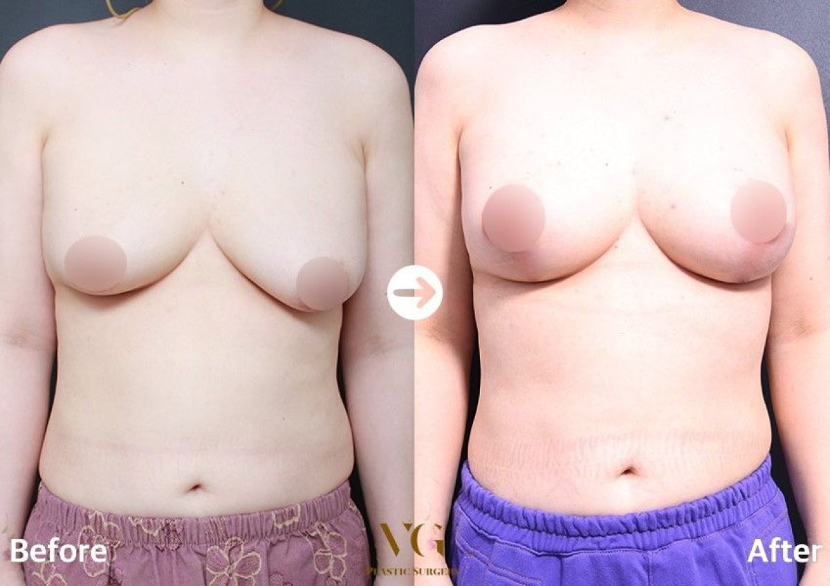 Before and after mommy makeover at VG Plastic Surgery, visible breast lift and body contour result