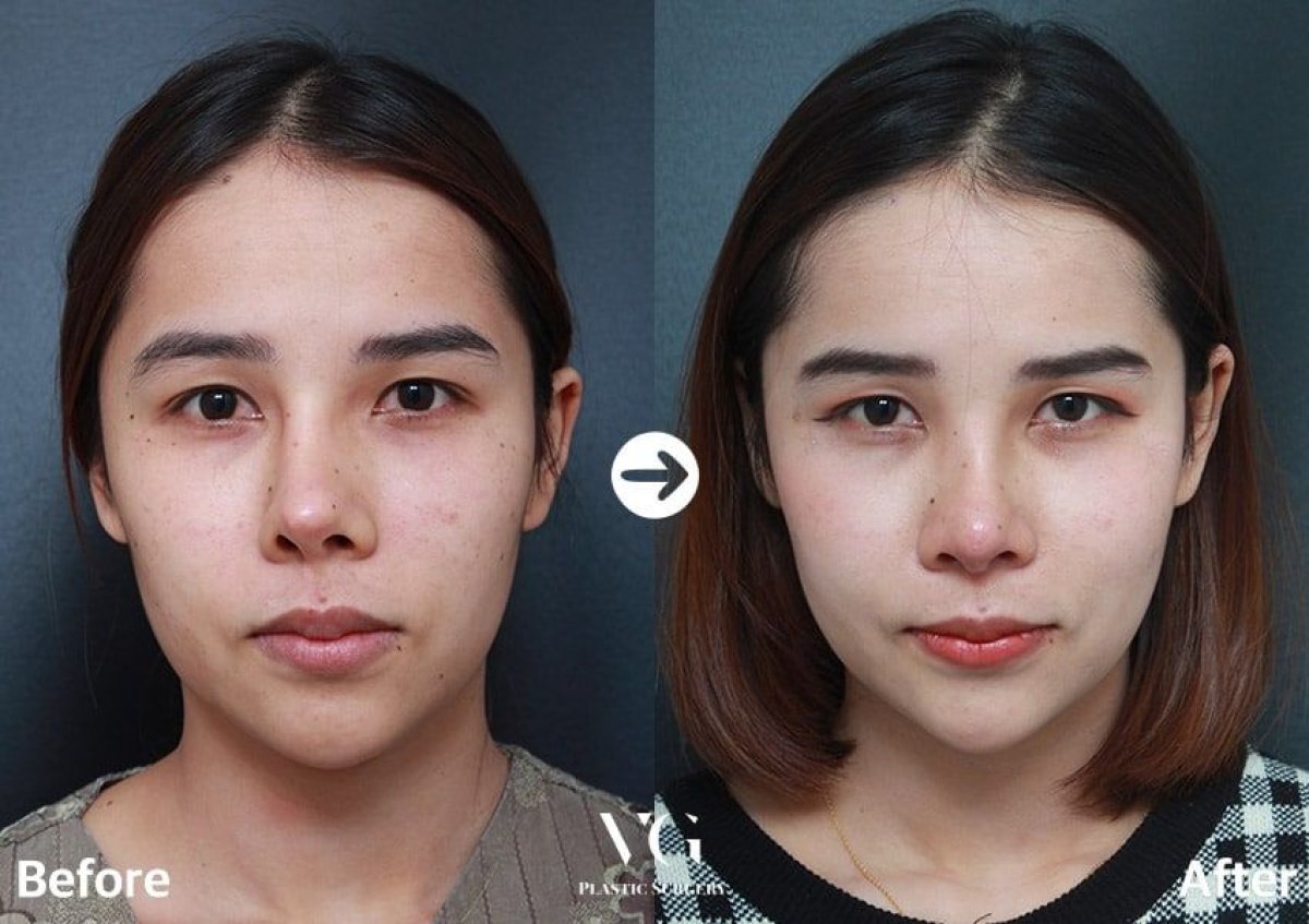 Deep Plane Facelift Vorher-Nachher-Ergebnis bei VG Plastic Surgery – sichtbare Verjüngung