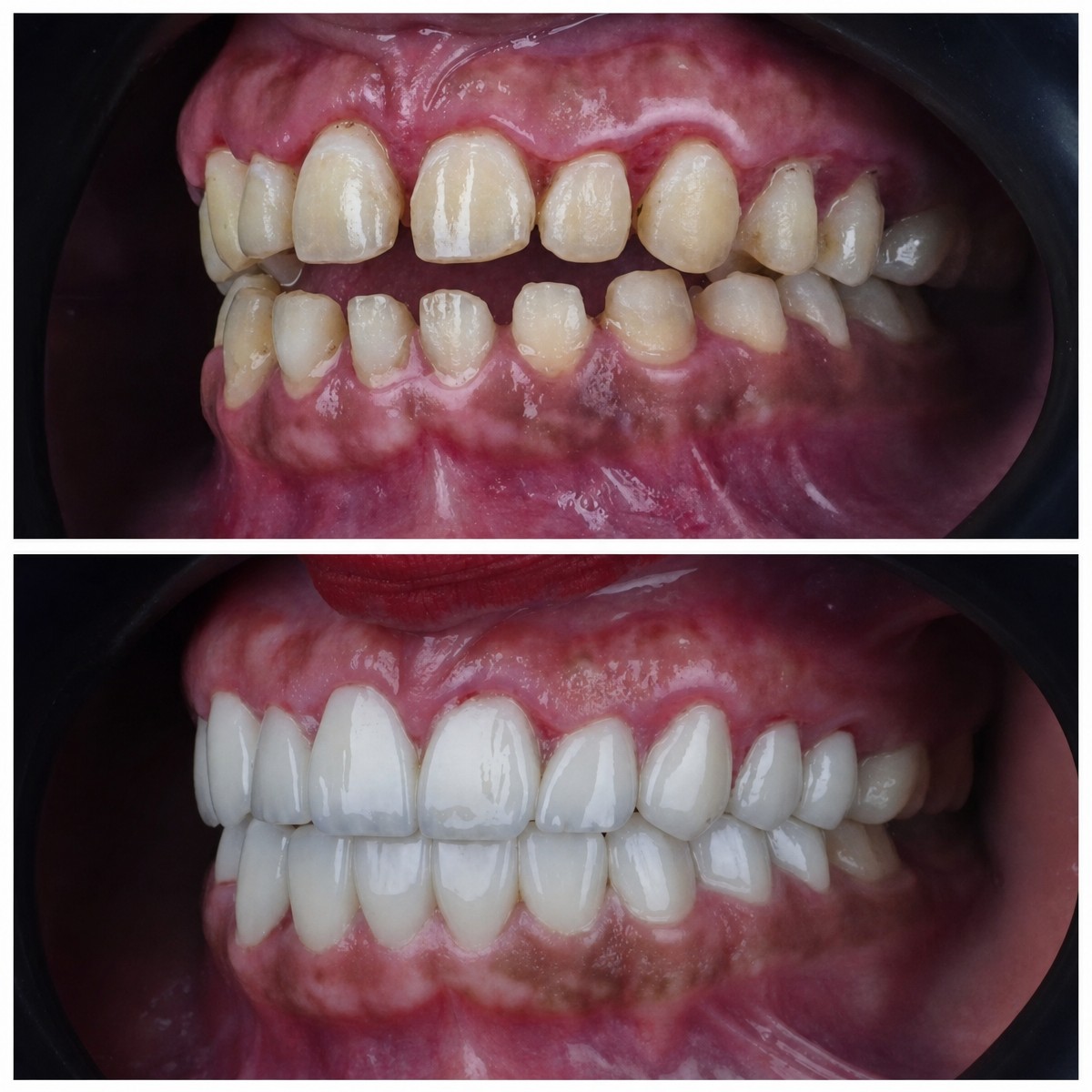 Vorher-nachher-Ergebnis Zirkonkrone bei Omara Dental Centers, Lächeln-Transformation