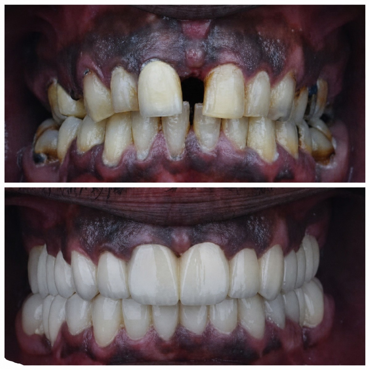 Before and after zirconia crown installation results at Omara Dental Centers, smile restoration
