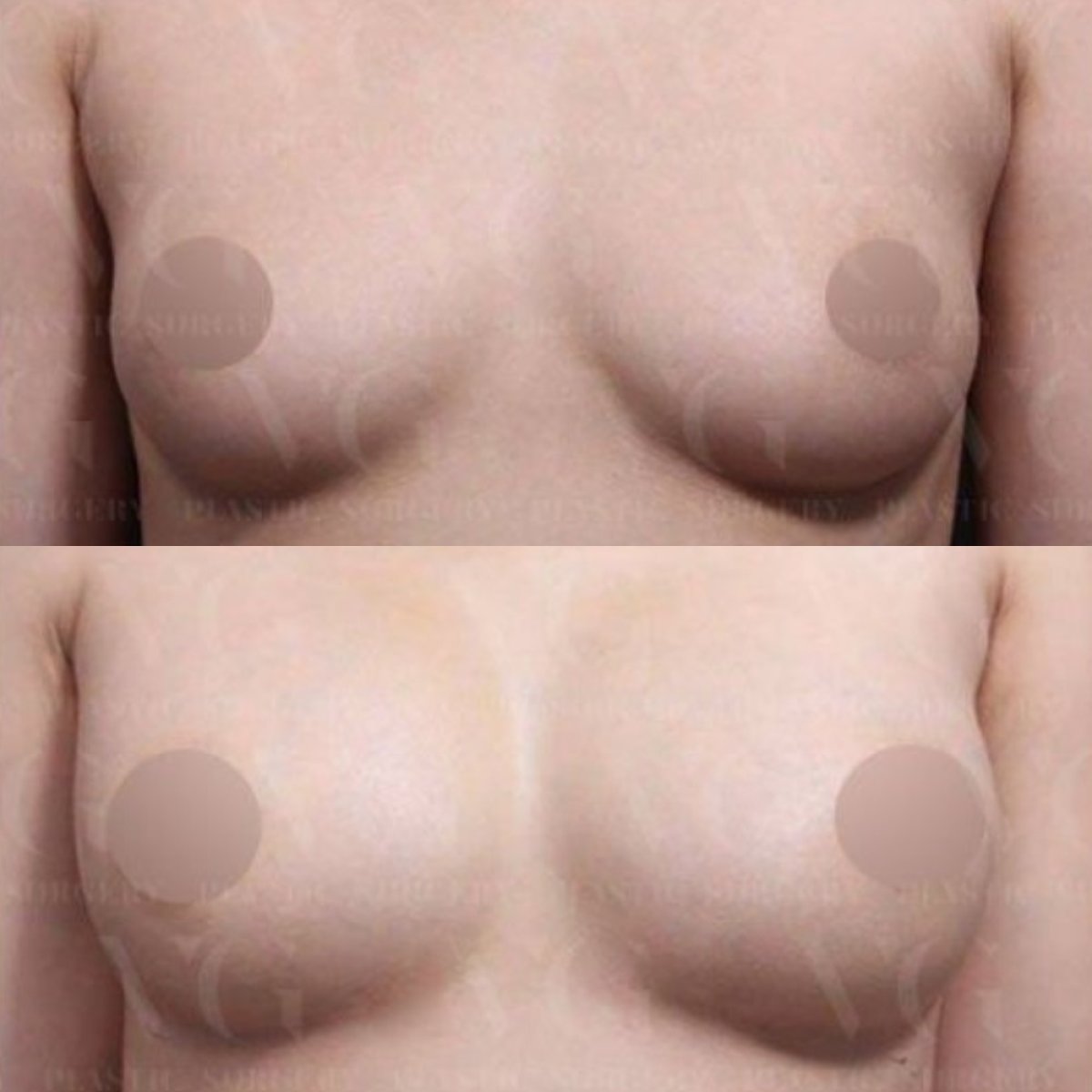 Avant-après augmentation mammaire par lipofilling chez VG Plastic Surgery, résultat naturel