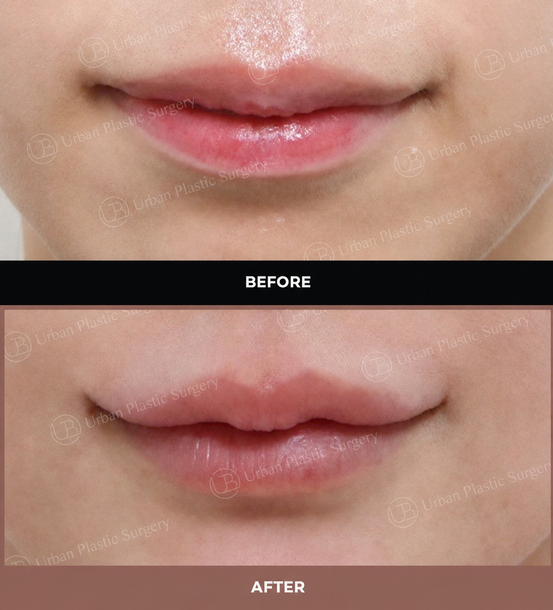 Resultados de antes y después de lip lift en URBAN Plastic Surgery – contorno mejorado