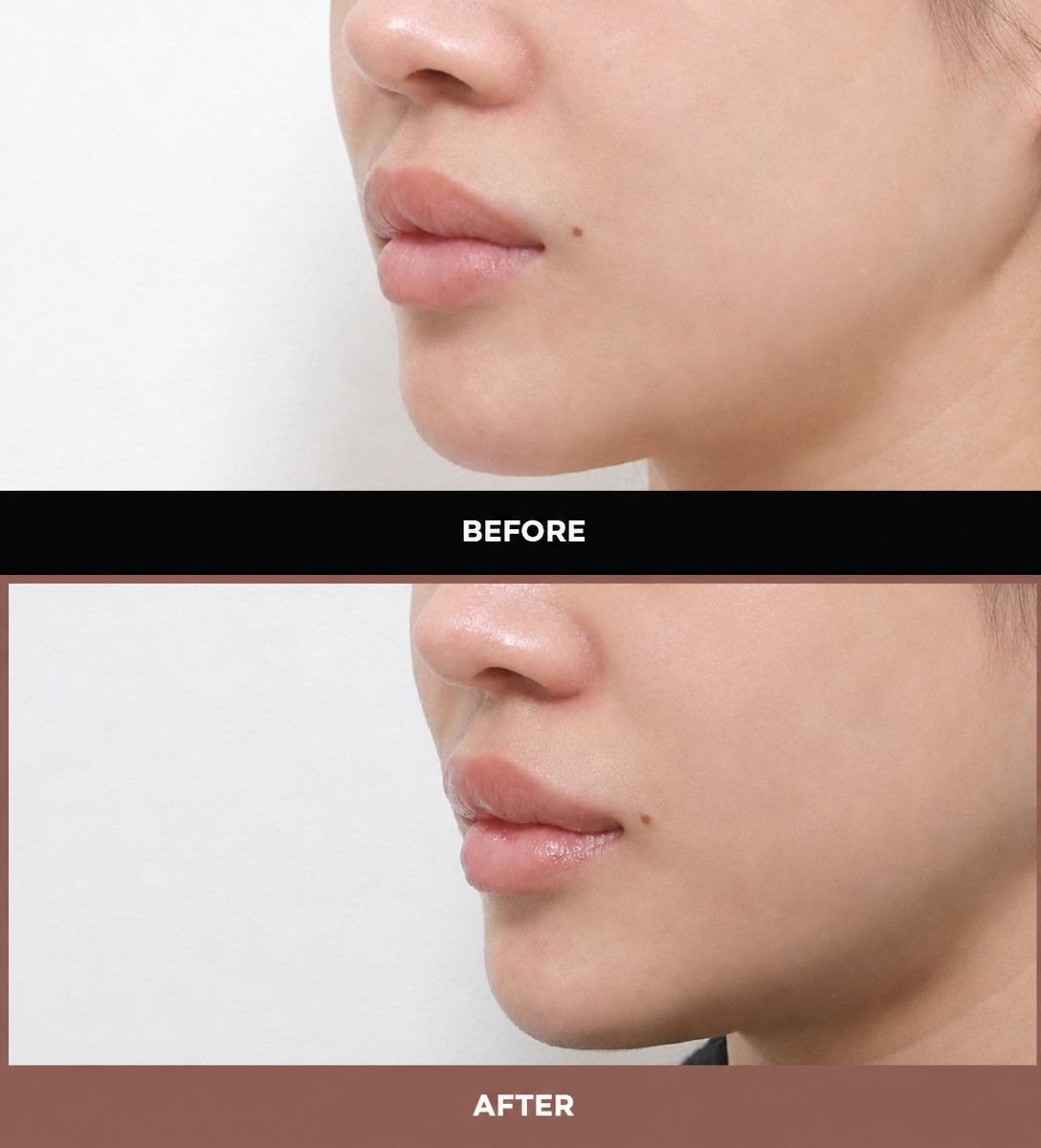 Resultados de lip lift antes y después en URBAN Plastic Surgery, contorno de labios mejorado