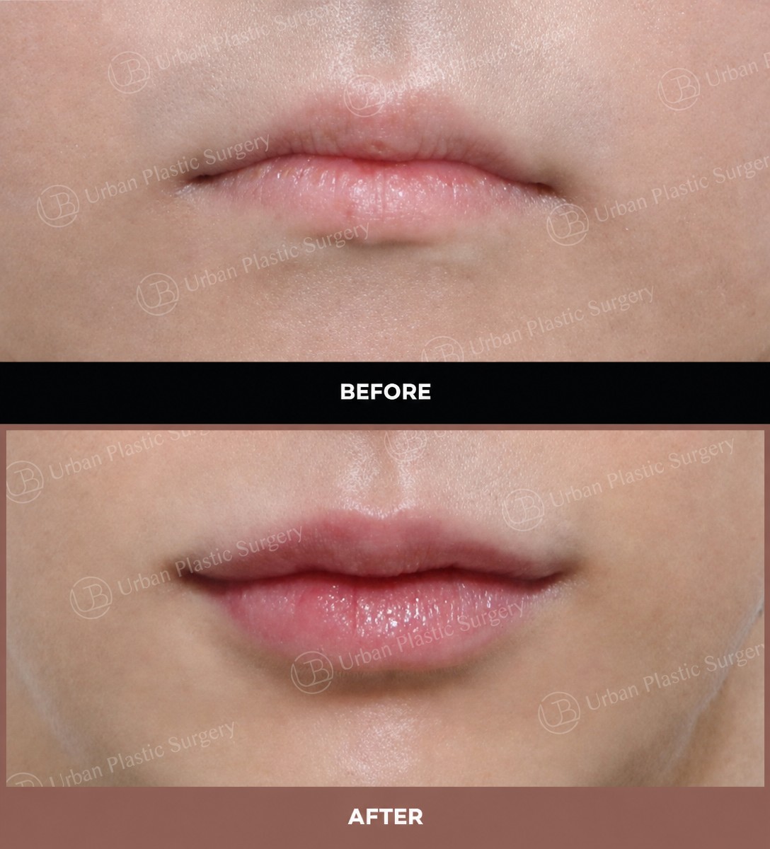 Efekty przed i po lip lift w URBAN Plastic Surgery, poprawiony kontur ust