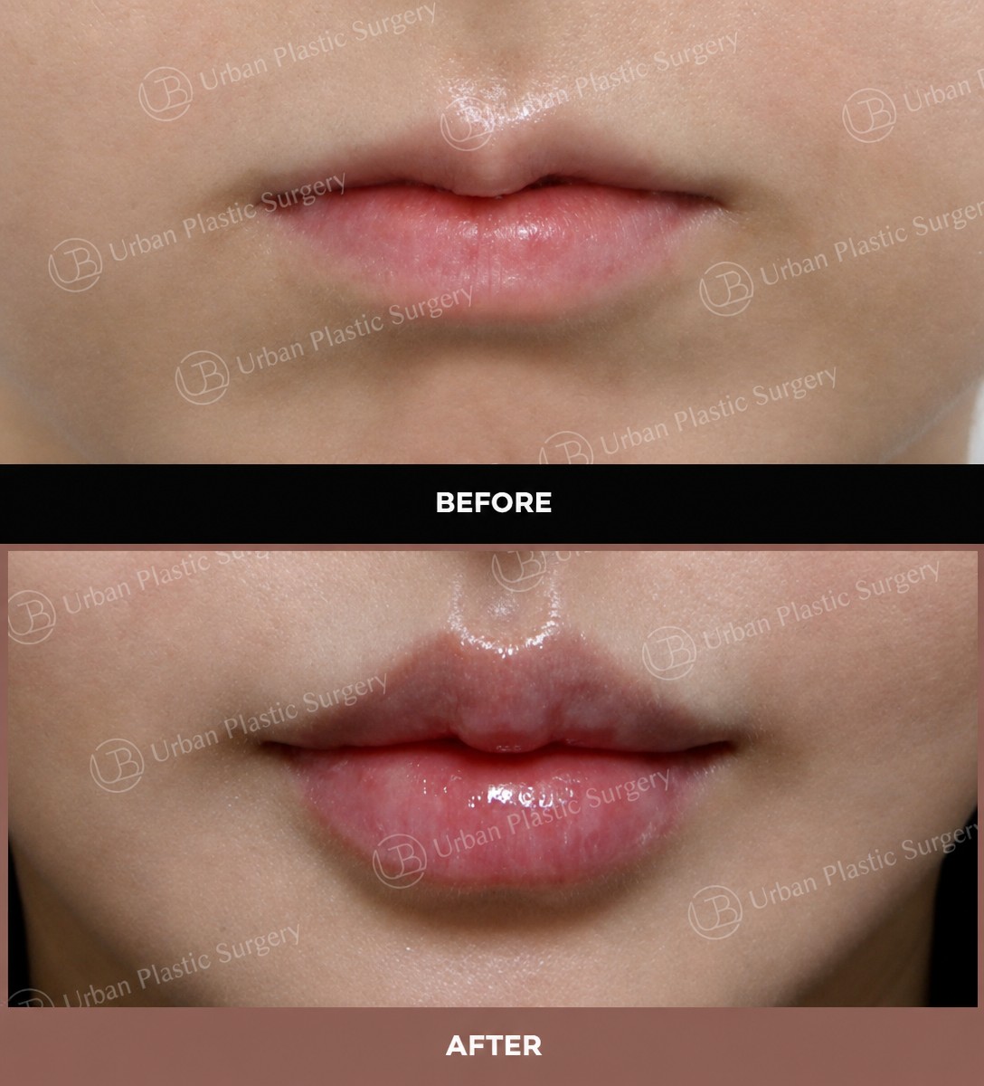 Résultats avant/après lip lift chez URBAN Plastic Surgery – contour des lèvres amélioré